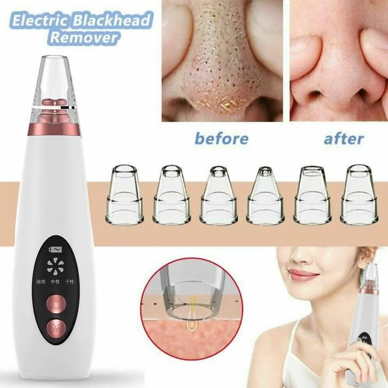 Revitalize Your Skin with the USB Charging Face Pore Vacuum: Ultimate Blackhead & Acne Remover for Deep Cleansing and Flawless Skin