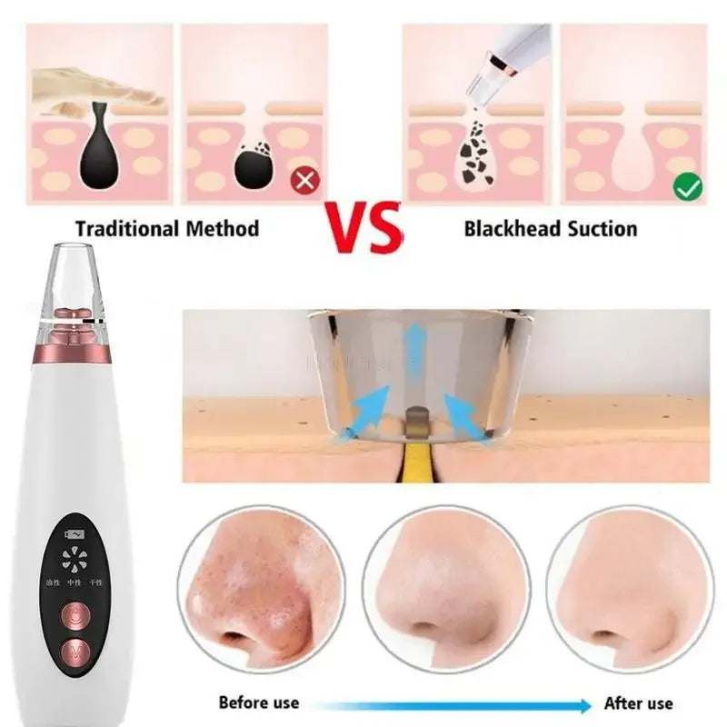 Revitalize Your Skin with the USB Charging Face Pore Vacuum: Ultimate Blackhead & Acne Remover for Deep Cleansing and Flawless Skin
